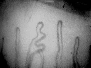 颈椎病甲襞微循环改变的临床观察